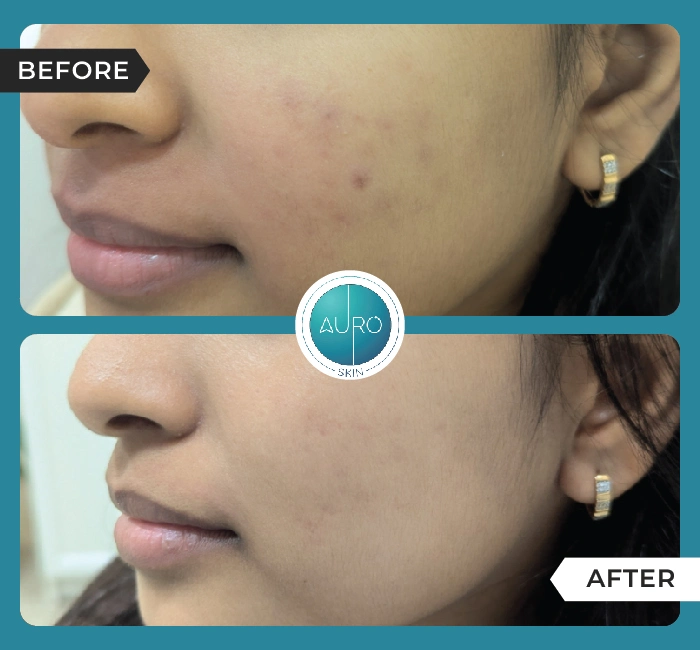Home 31 ACNE Medical Line of Treatment