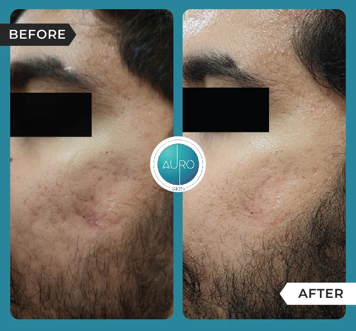 Home 32 Acne Scar Treatment Dermapen