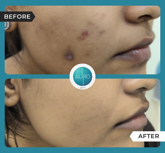 Home 33 Acne scar treatment