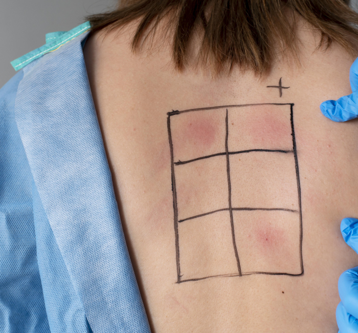 Allergy Testing Service in Mumbai