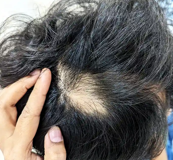 Alopecia