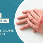 Atopic Dermatitis Guide: Symptoms, Causes & Treatment
