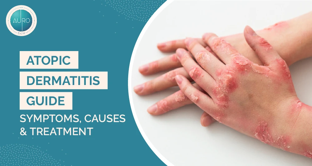 Atopic Dermatitis Guide: Symptoms, Causes & Treatment 1 Atopic Dermatitis Guide Symptoms Causes Treatment