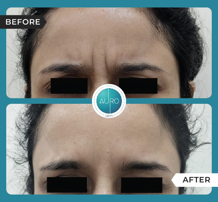 Home 35 BOTOX® treatment