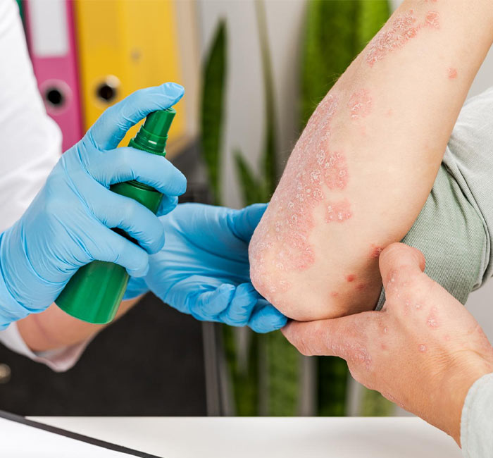 Benefits of Psoriasis Treatment