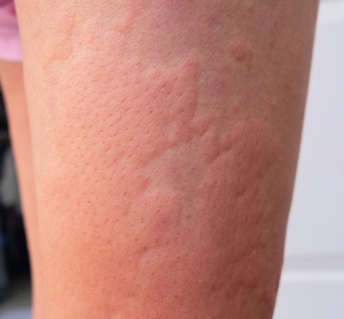 Benefits of Urticaria Treatment