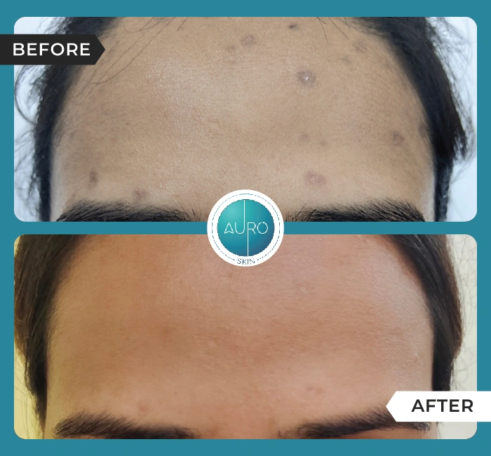 Home 36 Chicken Pox Marks Treatment using Peel LASER