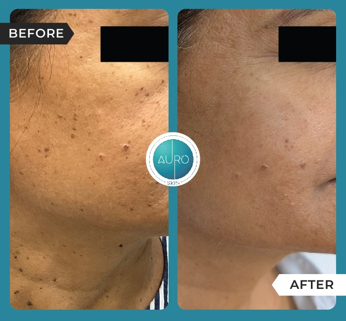 Home 38 DPN Removal