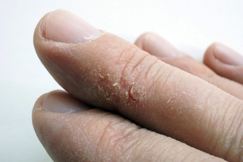 dry skin care