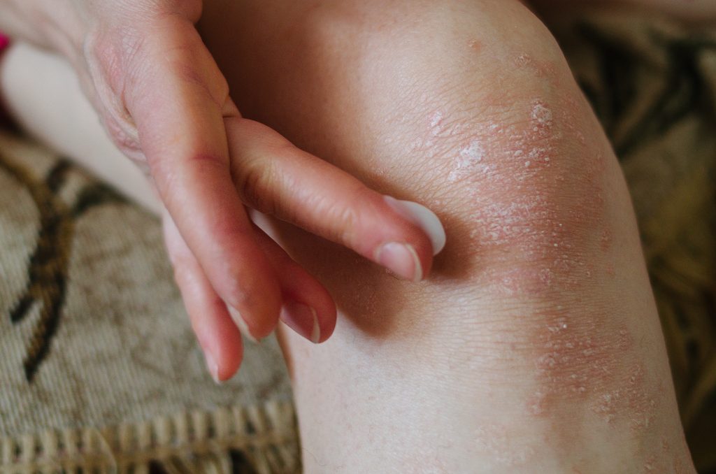 dry skin