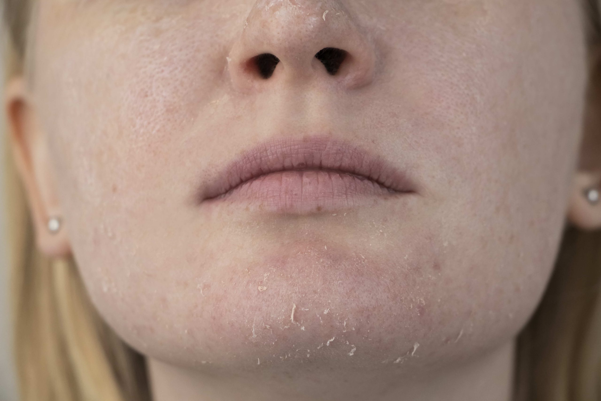 dry skin