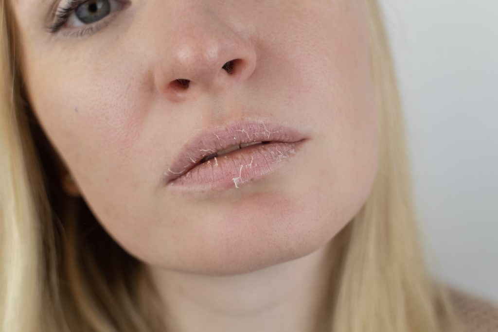 dry skin treatment
