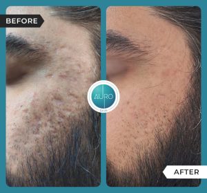 Dermapen vs. RF Microneedling: Key Differences 2 Dermapen Microneedling Treatment