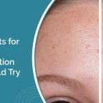 Effective Treatments for Forehead Pigmentation You Should Try