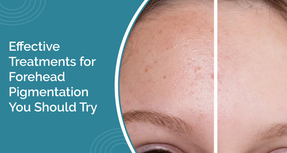 Effective Treatments for Forehead Pigmentation You Should Try