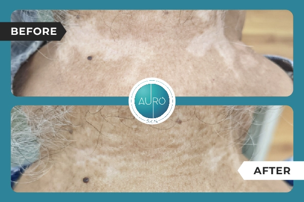 Eximer for Vitiligo before and after image