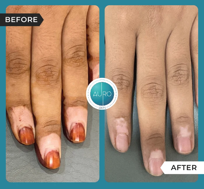 Home 40 Eximer for Vitiligo