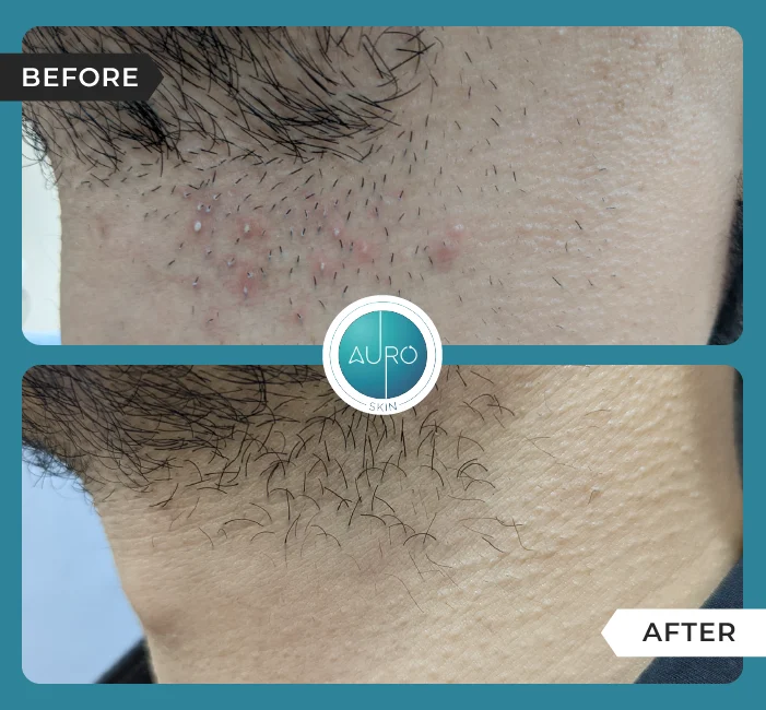 Folliculitis Before After Image