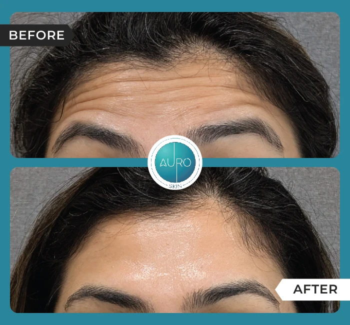 Home 41 Forehead BOTOX treatment
