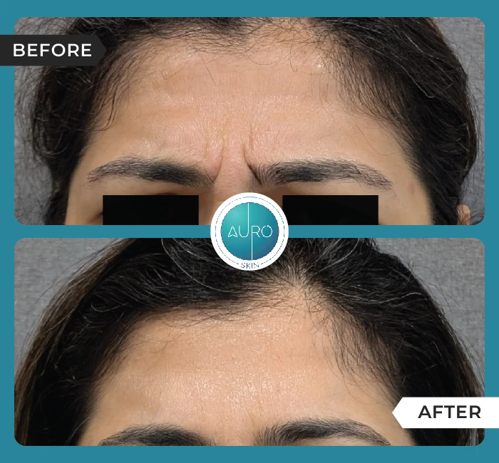 Home 42 Forehead BOTOX® treatment