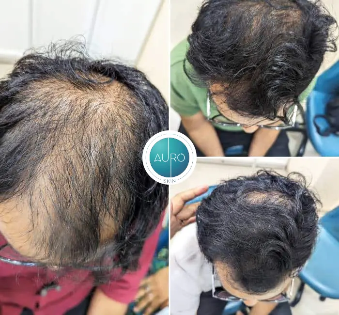 Hair Treatment in Mumbai
