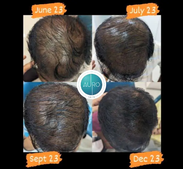 Hair Treatment in Vileparle