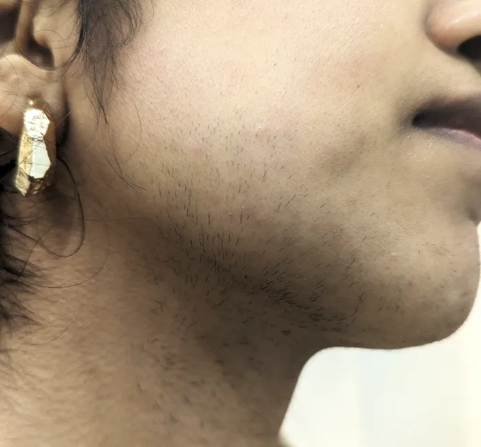 Hirsutism