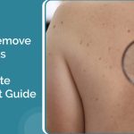 How to Remove Birthmarks Safely: A Complete Treatment Guide