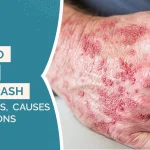 How to Treat Drug Rash: Symptoms, Causes & Solutions