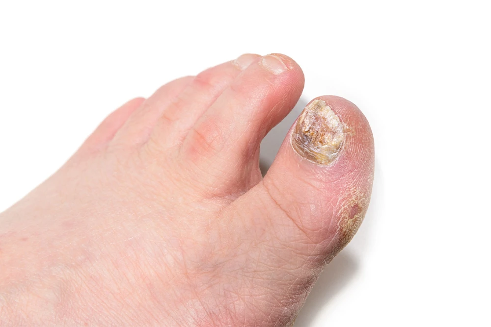 Ingrown toe nail