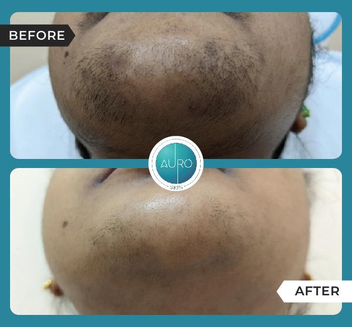 Home 43 Laser hair reduction