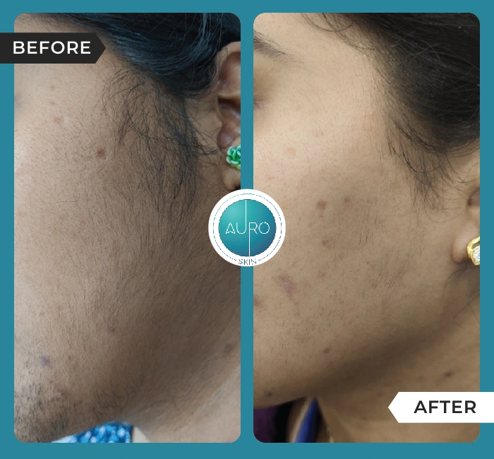 Home 44 Laser hair reduction