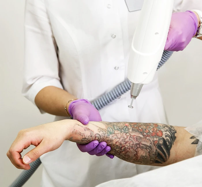 Laser tattoo removal