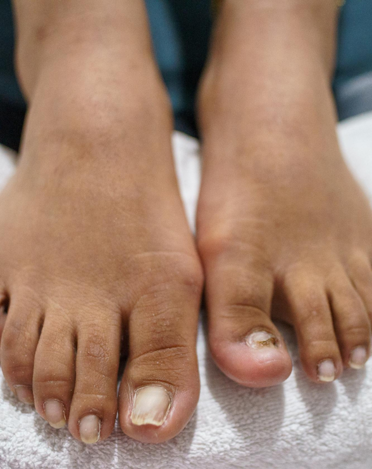 NAIL treatment