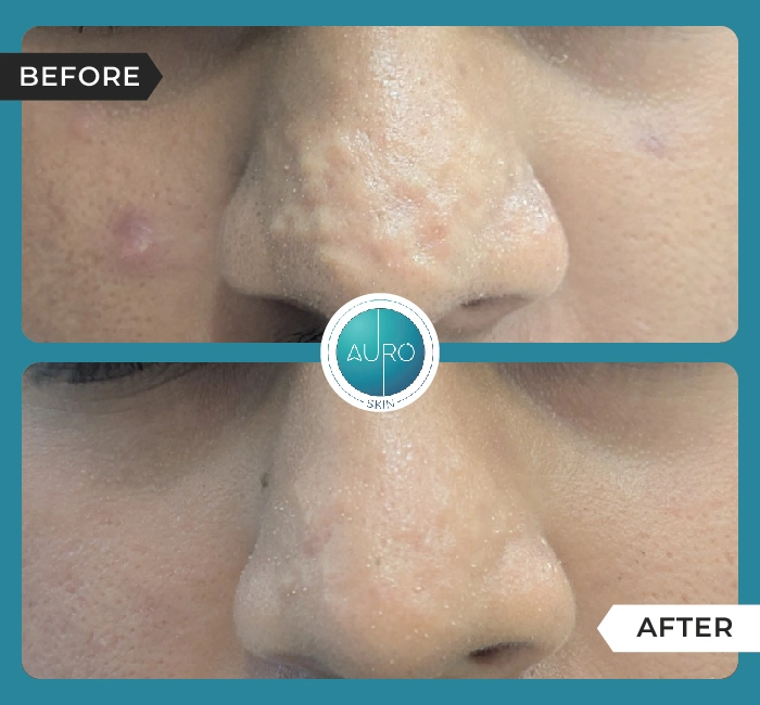 Home 45 Papular Scar Treatment