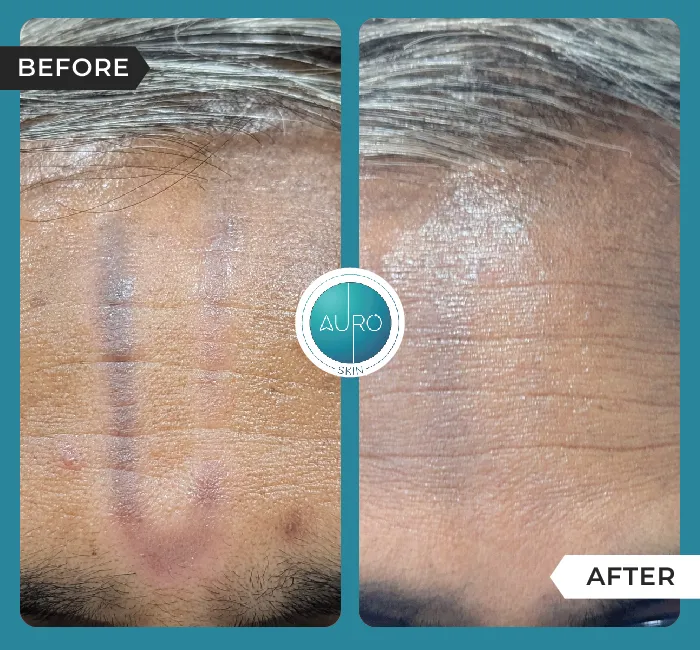 Home 46 Pigmentation after Friction