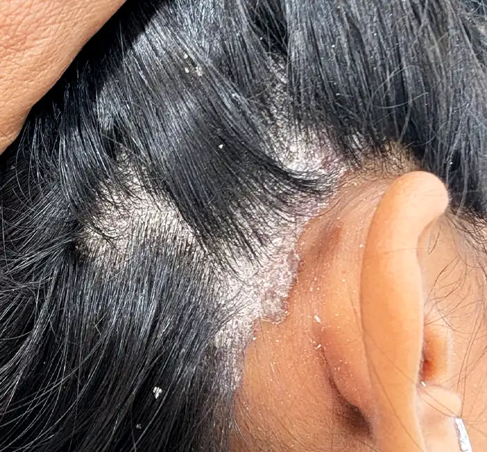 Psoriasis
