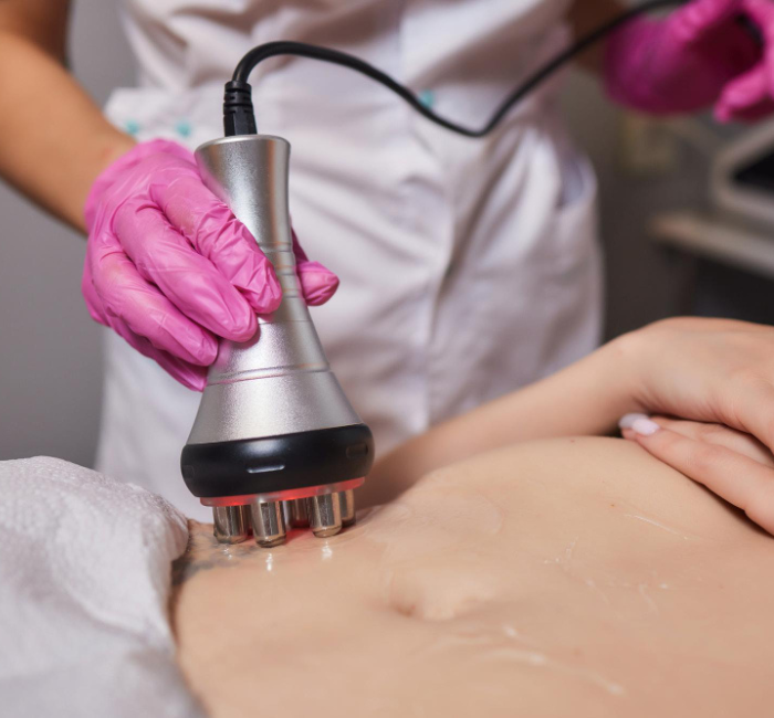 RF Skin Tightening Treatment 2