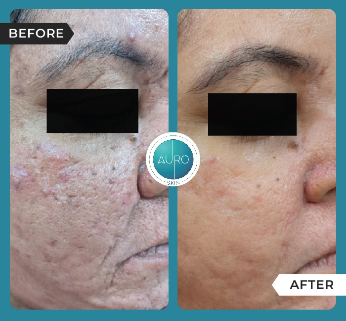Home 47 Roseacea Treatment