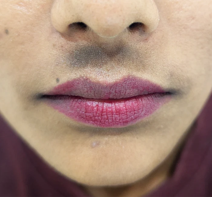 Skin Pigmentation 1
