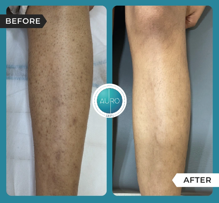 Home 48 Strawberry legs Laser hair reduction 2
