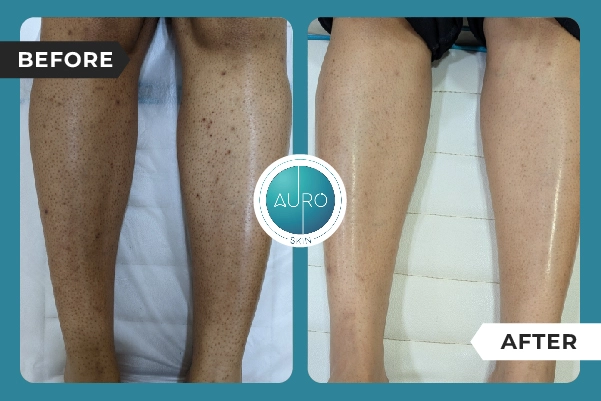 Strawberry legs Laser hair reduction before and after image