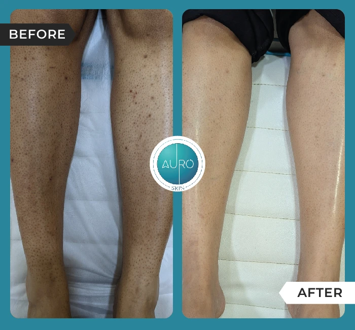 Home 49 Strawberry legs Laser hair reduction