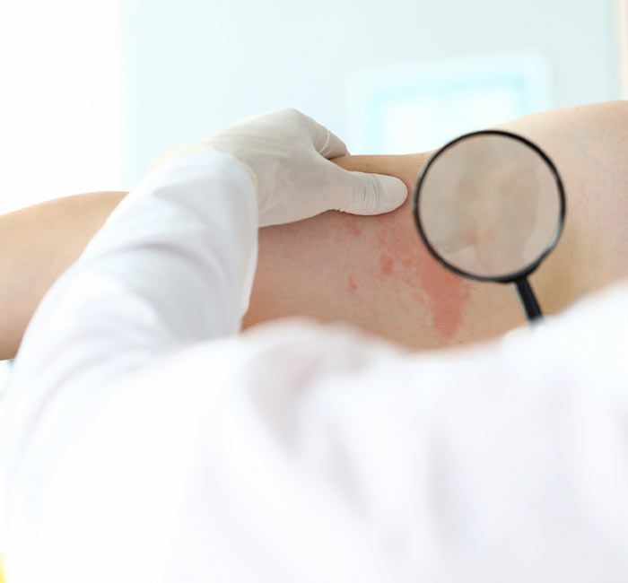 Urticaria Treatment Procedure