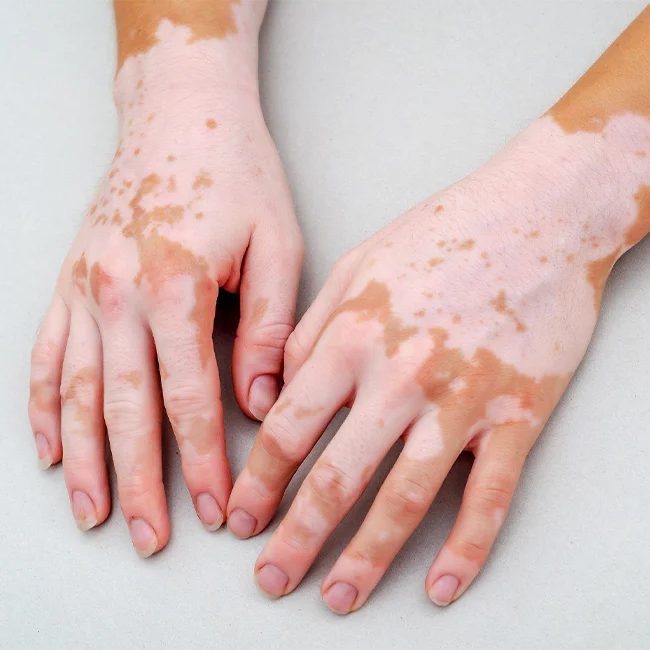 Vitiligo