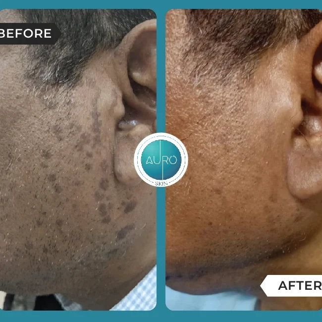 Warts Medical line of treatment