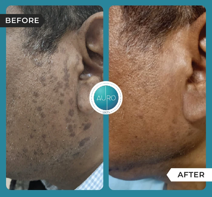 Home 50 Warts Medical line of treatment
