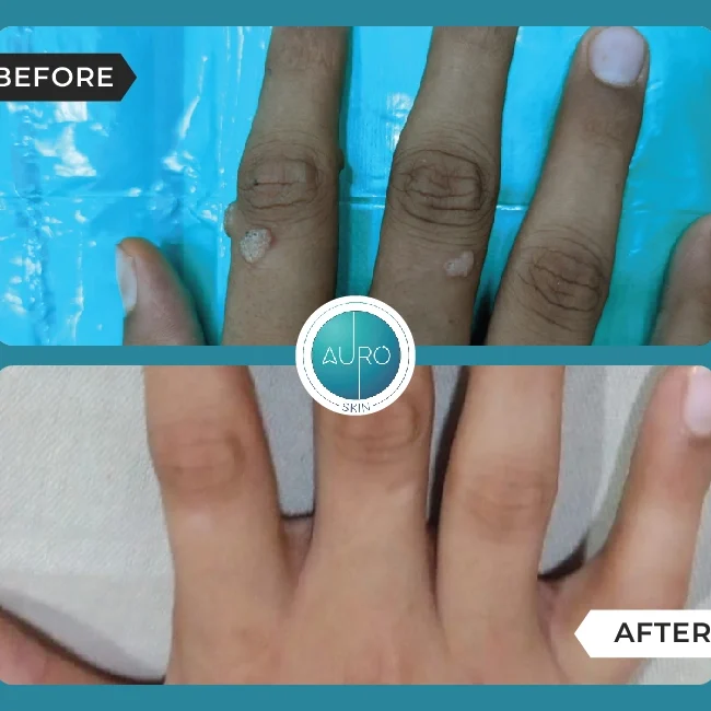 Warts Removal