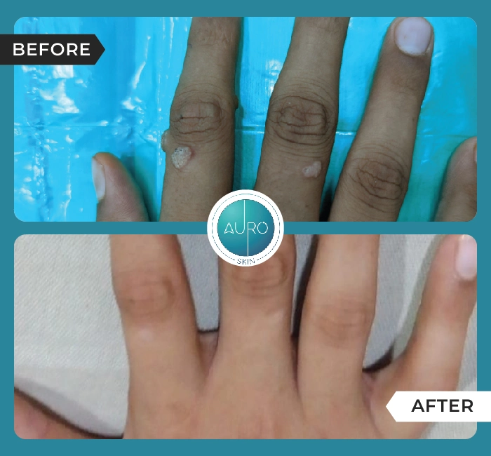 Home 51 Warts Removal