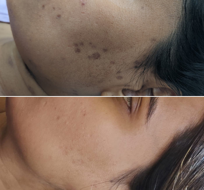 What Is Laser Pigmentation